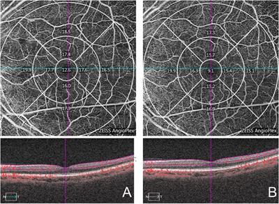 Evaluation of Macular and Peripapillary Blood Flow in Response to Intraocular Pressure Reduction in Patients With Posner–Schlossman Syndrome